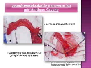 oesophagocoloplastie transverse iso
            péristaltique Gauche


                                   3-Levée du transplant colique




  3



4-Anastomose colo-gastrique à la
   face postérieure de l’antre
                                      4
                                          Les oesophagocoloplasties chez l’enfant:
                                          Indications, techniques et résultats à propos de 36 cas
                                          Thèse de Mariem khalfallah 2008
 