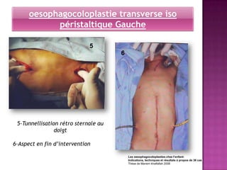 oesophagocoloplastie transverse iso
            péristaltique Gauche

                             5
                                      6




 5-Tunnellisation rétro sternale au
                doigt

6-Aspect en fin d’intervention

                                          Les oesophagocoloplasties chez l’enfant:
                                          Indications, techniques et résultats à propos de 36 cas
                                          Thèse de Mariem khalfallah 2008
 