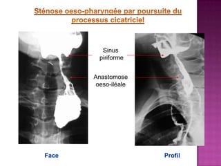 Sinus
         piriforme


       Anastomose
        oeso-iléale




Face                  Profil
 