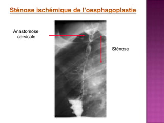 Anastomose
 cervicale

             Sténose
 