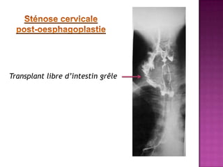 Transplant libre d’intestin grêle
 