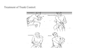 Treatment of Trunk Control:
 