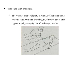 • Homolateral Limb Synkinesis
• The response of one extremity to stimulus will elicit the same
response in its epsilateral extremity, i.e, efforts at flexion of an
upper extremity causes flexion of the lower extremity.
 