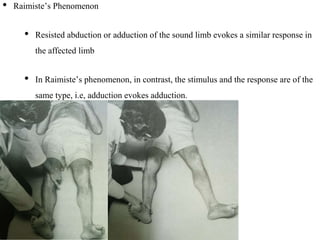 • Raimiste’s Phenomenon
• Resisted abduction or adduction of the sound limb evokes a similar response in
the affected limb
• In Raimiste’s phenomenon, in contrast, the stimulus and the response are of the
same type, i.e, adduction evokes adduction.
 