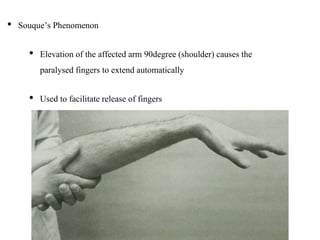 • Souque’s Phenomenon
• Elevation of the affected arm 90degree (shoulder) causes the
paralysed fingers to extend automatically
• Used to facilitate release of fingers
 
