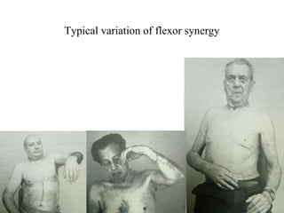 Typical variation of flexor synergy
 