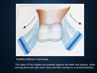 The sides of the bristles are pressed against the teeth and gingiva, while
moving the brush with short ‘back and forth’ st...
