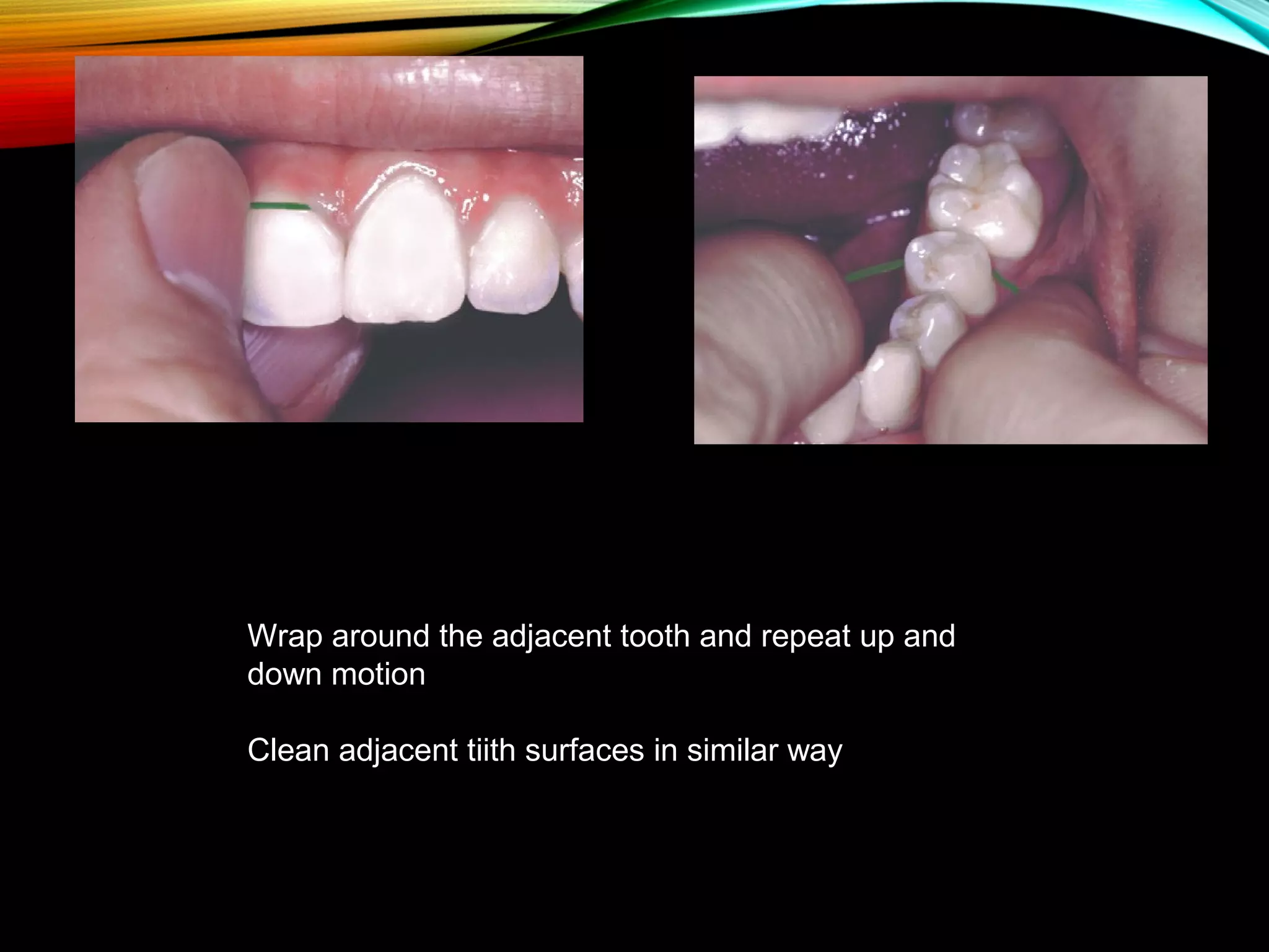 Wrap around the adjacent tooth and repeat up and
down motion
Clean adjacent tiith surfaces in similar way
 