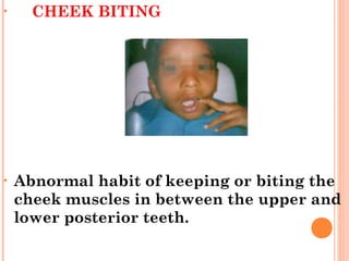 • CHEEK BITING
• Abnormal habit of keeping or biting the
cheek muscles in between the upper and
lower posterior teeth.
 