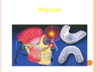 Bruxism
 