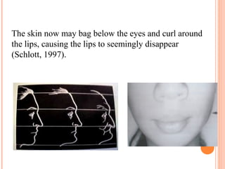 The skin now may bag below the eyes and curl around
the lips, causing the lips to seemingly disappear
(Schlott, 1997).
 