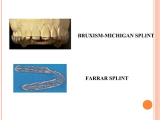 BRUXISM-MICHIGAN SPLINT
FARRAR SPLINT
 