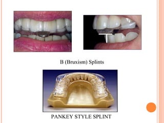PANKEY STYLE SPLINT
B (Bruxism) Splints
 