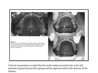 Bruxism and its management | PPTX