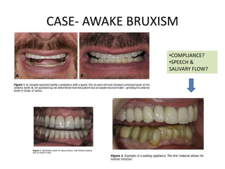 Bruxism and its management | PPTX