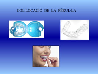 COL·LOCACIÓ  DE  LA  FÈRUL·LA 