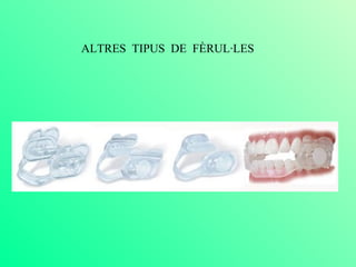 ALTRES  TIPUS  DE  FÈRUL·LES 