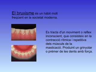 El bruxisme  és un hàbit molt freqüent en la societat moderna.  Es tracta d'un moviment o reflex inconscient, que consisteix en la contracció rítmica i repetitiva dels músculs de la masticació.Produint un grinyolar o prémer de les dents amb força.  