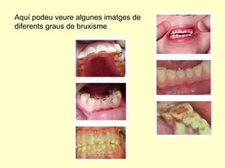 Aquí podeu veure algunes imatges de diferents graus de bruxisme 