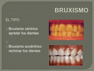 EL TIPO
 Bruxismo céntrico
apretar los dientes

 Bruxismo excéntrico
rechinar los dientes
 