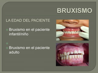LA EDAD DEL PACIENTE
 Bruxismo en el paciente
infantil/niño

 Bruxismo en el paciente
adulto
 