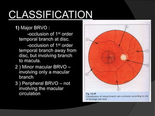 CLASSIFICATION
1) Major BRVO :
-occlusion of 1st order
temporal branch at disc.
-occlusion of 1st order
temporal branch away from
disc, but involving branch
to macula.
2 ) Minor macular BRVO –
involving only a macular
branch
3 ) Peripheral BRVO – not
involving the macular
circulation
 