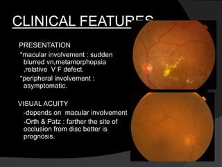 CLINICAL FEATURES
PRESENTATION
*macular involvement : sudden
blurred vn,metamorphopsia
,relative V F defect.
*peripheral involvement :
asymptomatic.
VISUAL ACUITY
-depends on macular involvement
-Orth & Patz : farther the site of
occlusion from disc better is
prognosis.
 