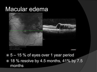 Macular edema
 5 – 15 % of eyes over 1 year period
 18 % resolve by 4.5 months, 41% by 7.5
months
 