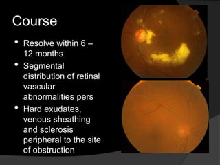 Course
• Resolve within 6 –
12 months
• Segmental
distribution of retinal
vascular
abnormalities pers
• Hard exudates,
venous sheathing
and sclerosis
peripheral to the site
of obstruction
 