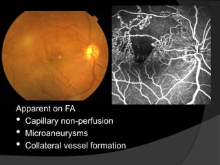 Apparent on FA
• Capillary non-perfusion
• Microaneurysms
• Collateral vessel formation
 