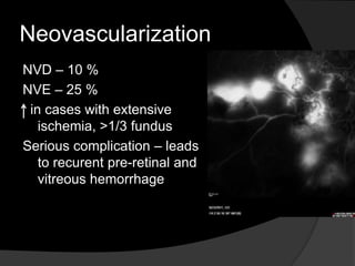 Neovascularization
NVD – 10 %
NVE – 25 %
in cases with extensive
ischemia, >1/3 fundus
Serious complication – leads
to recurent pre-retinal and
vitreous hemorrhage
 