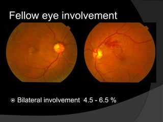Fellow eye involvement
 Bilateral involvement 4.5 - 6.5 %
 