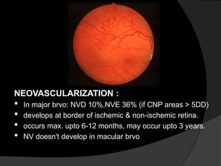 NEOVASCULARIZATION :
• In major brvo: NVD 10%,NVE 36% (if CNP areas > 5DD)
• develops at border of ischemic & non-ischemic retina.
• occurs max. upto 6-12 months, may occur upto 3 years.
• NV doesn't develop in macular brvo
 