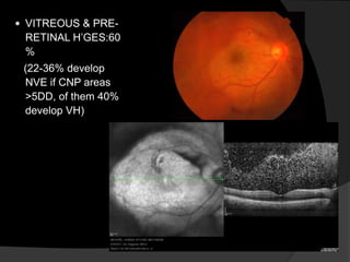  VITREOUS & PRE-
RETINAL H’GES:60
%
(22-36% develop
NVE if CNP areas
>5DD, of them 40%
develop VH)
 