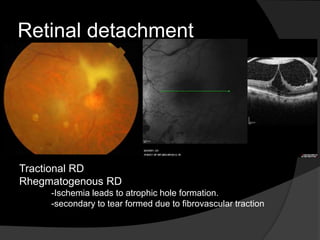 Tractional RD
Rhegmatogenous RD
-Ischemia leads to atrophic hole formation.
-secondary to tear formed due to fibrovascular traction
Retinal detachment
 