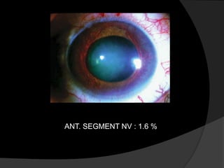 ANT. SEGMENT NV : 1.6 %
 