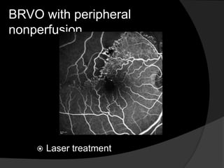 BRVO with peripheral
nonperfusion
 Laser treatment
 