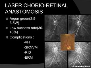 LASER CHORIO-RETINAL
ANASTOMOSIS
 Argon green(2.5-
3.5W)
 Low success rate(30-
40%)
 Complications :
-VH
-SRNVM
-R.D
-ERM
 