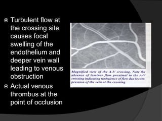  Turbulent flow at
the crossing site
causes focal
swelling of the
endothelium and
deeper vein wall
leading to venous
obstruction
 Actual venous
thrombus at the
point of occlusion
 