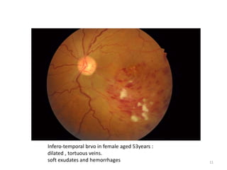 Infero-temporal brvo in female aged 53years :
dilated , tortuous veins.
soft exudates and hemorrhages 11
 