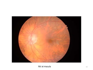 NV at macula 13
 