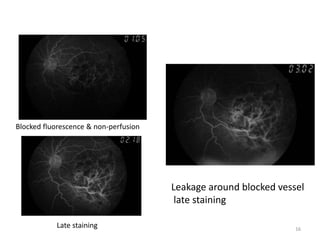 Blocked fluorescence & non-perfusion
Late staining
Leakage around blocked vessel
late staining
16
 