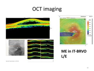 OCT imaging
ME in IT-BRVO
L/E
18
 