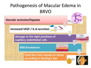 Pathogenesis of Macular Edema in
BRVO
Vascular occlusion/hypoxia
Increased VEGF / IL-6 secretion
damage to the tight junctions of
capillary endothelial cells
BRB Breakdown
Fluid flux from vessels to tissue
according to Starling's law
8
 