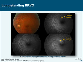 Collateral Fundus BRVO.ppt