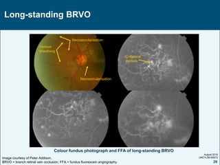Collateral Fundus BRVO.ppt