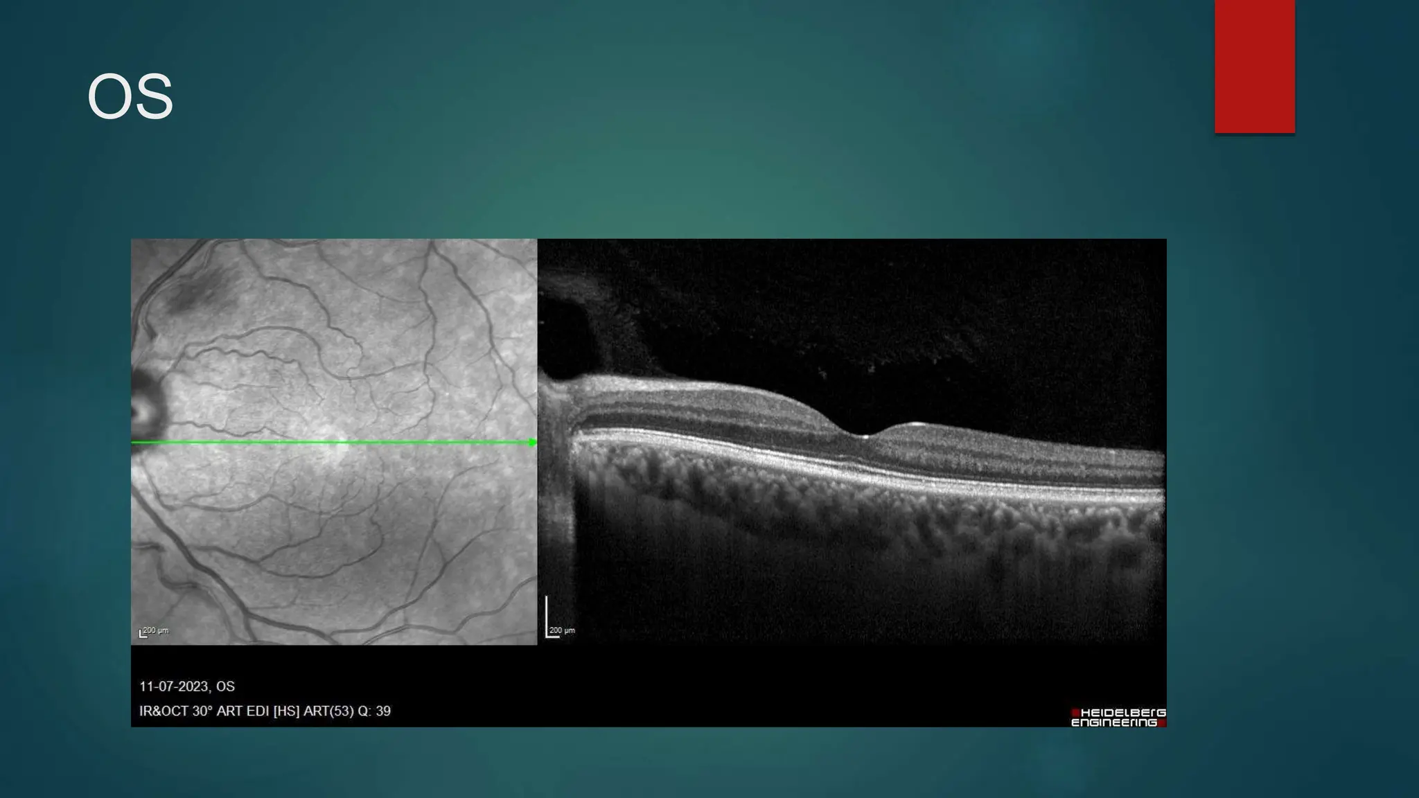 Branch retinal vein occlusion case presentation shine.pptx