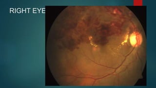 Branch retinal vein occlusion case presentation shine.pptx