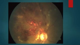 Branch retinal vein occlusion case presentation shine.pptx