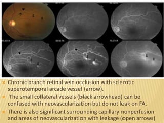  Chronic branch retinal vein occlusion with sclerotic
superotemporal arcade vessel (arrow).
 The small collateral vessels (black arrowhead) can be
confused with neovascularization but do not leak on FA.
 There is also significant surrounding capillary nonperfusion
and areas of neovascularization with leakage (open arrows)
 